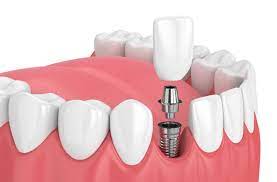 Dental Implants | Dentist in University City, MO | University Dental Care